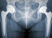 X-Ray of someones pelvic area
